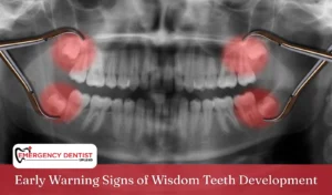 Early Warning Signs of Wisdom Teeth Development