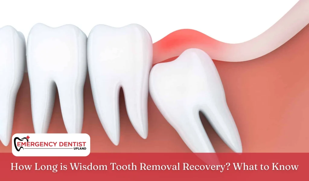 How Long is Wisdom Tooth Removal Recovery What to Know