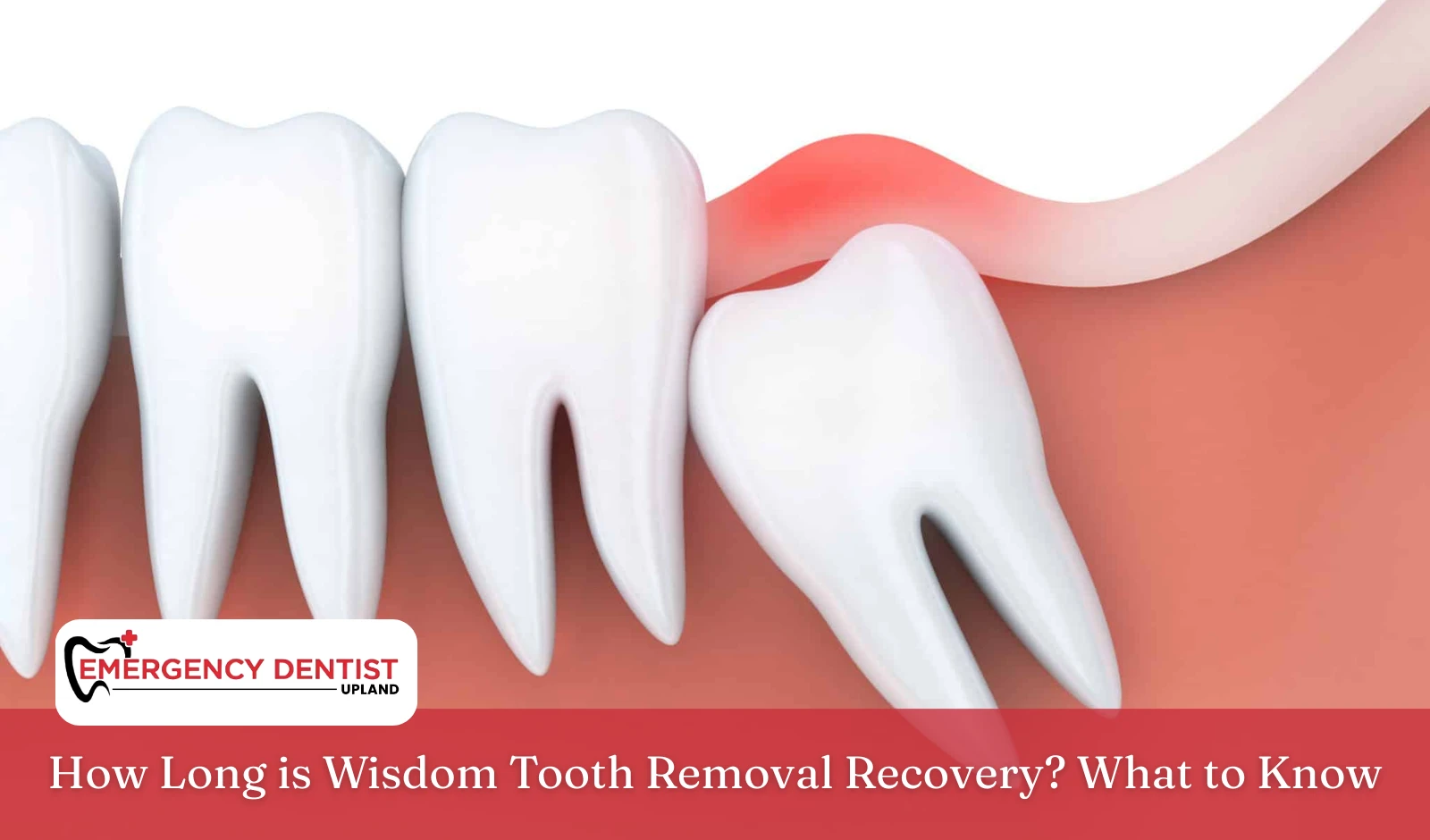 How Long is Wisdom Tooth Removal Recovery What to Know