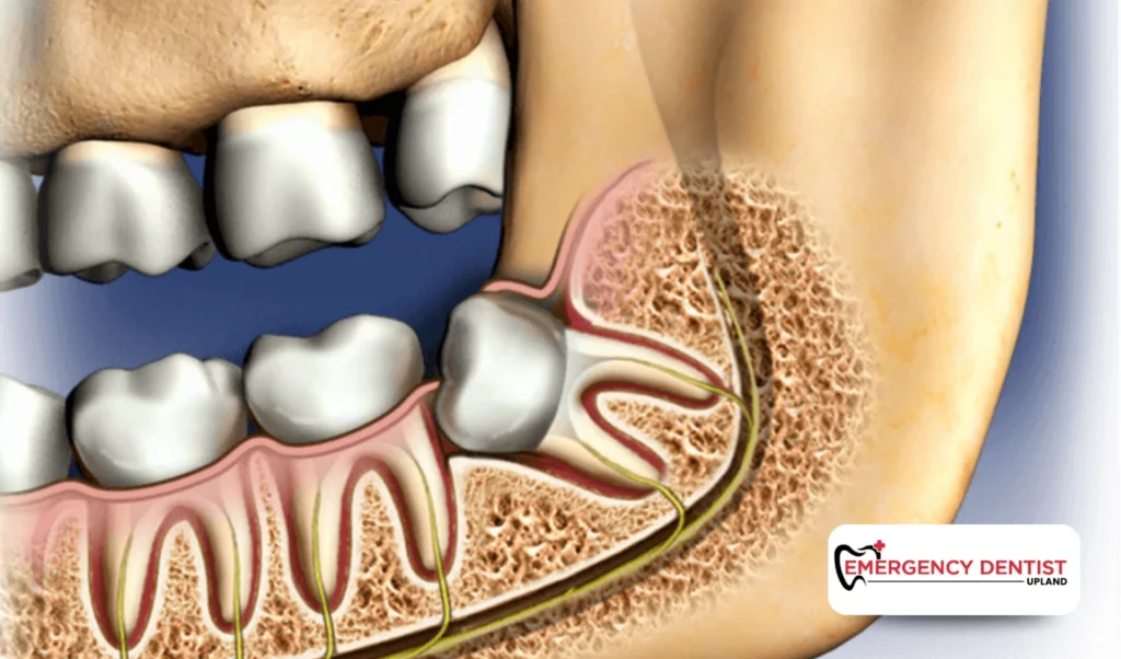 What Wisdom Tooth Removal Typically Involves