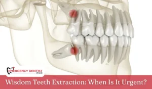 Wisdom Teeth Extraction When Is It Urgent
