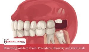Removing Wisdom Tooth Procedure, Recovery and Care Guide
