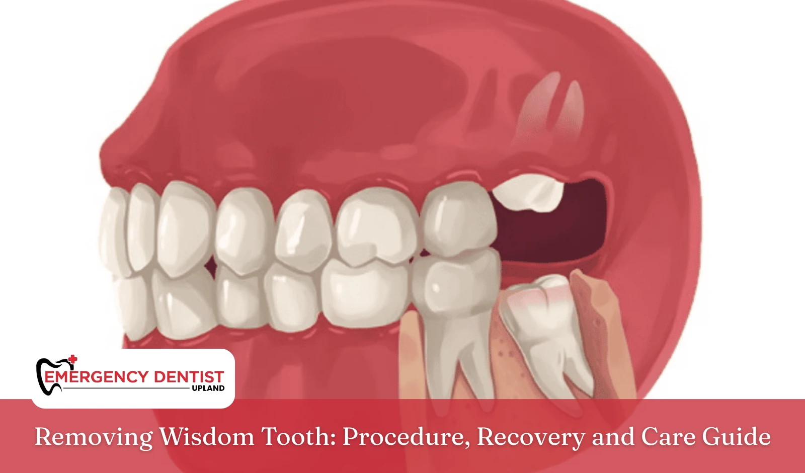 Removing Wisdom Tooth Procedure, Recovery and Care Guide
