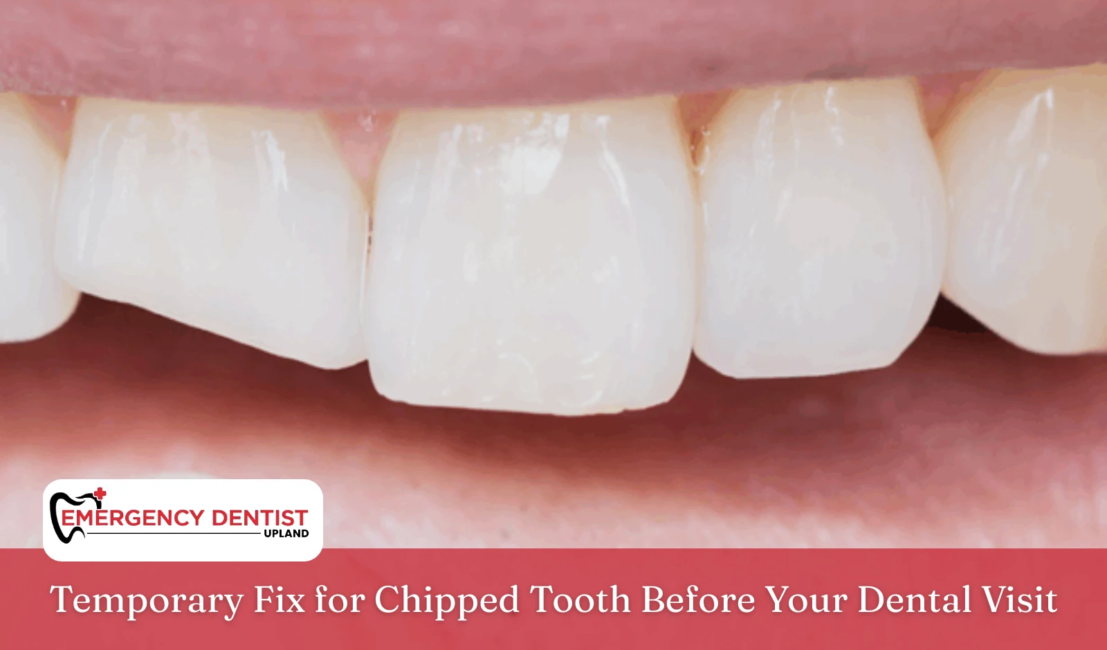 Temporary Fix for Chipped Tooth Before Your Dental Visit