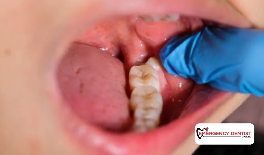 The First 24 Hours After Oral Surgery