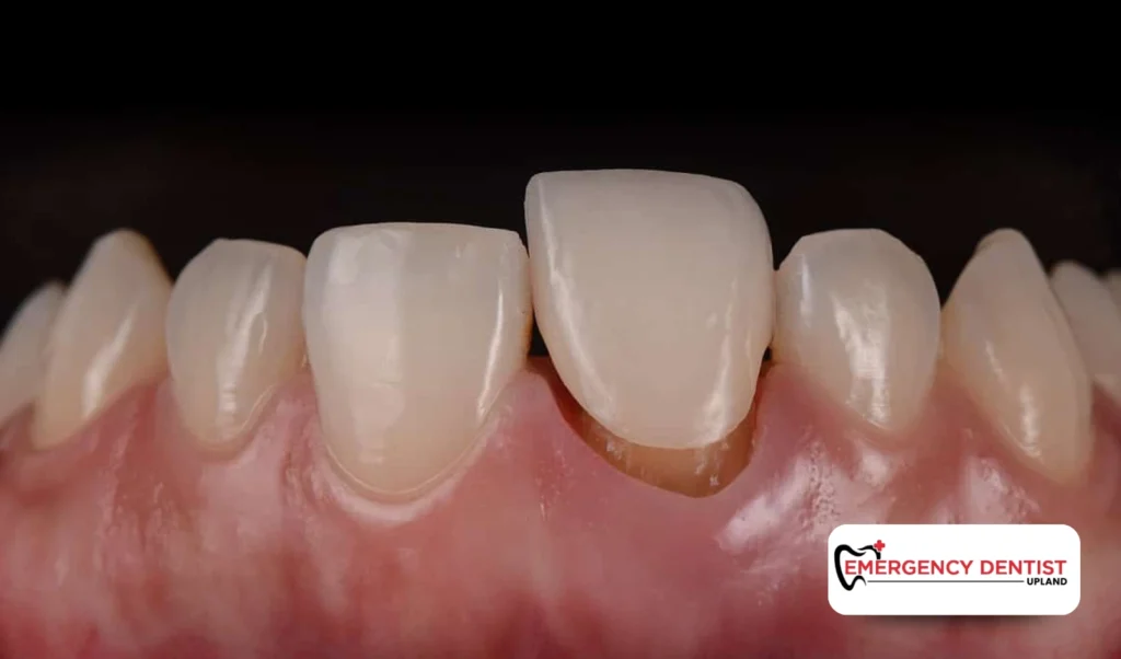 Tooth Pain After Crown Placement