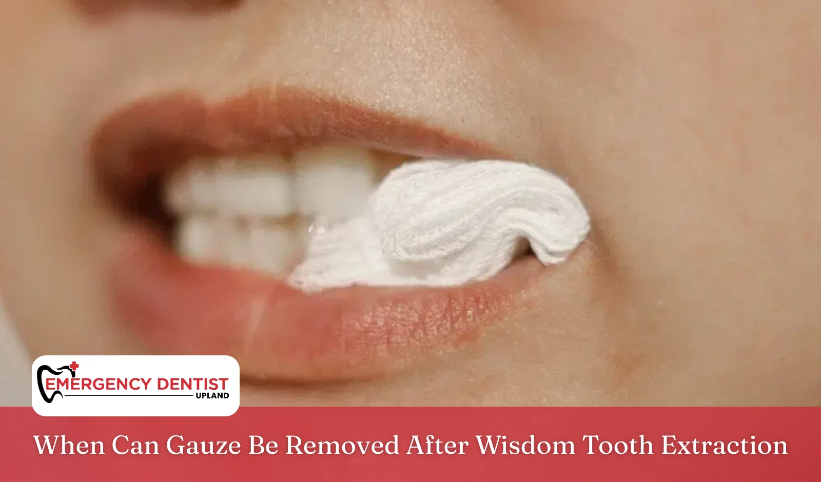 When Can Gauze Be Removed After Wisdom Tooth Extraction