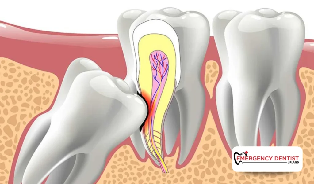 Why Wisdom Tooth Removal Is Often Recommended