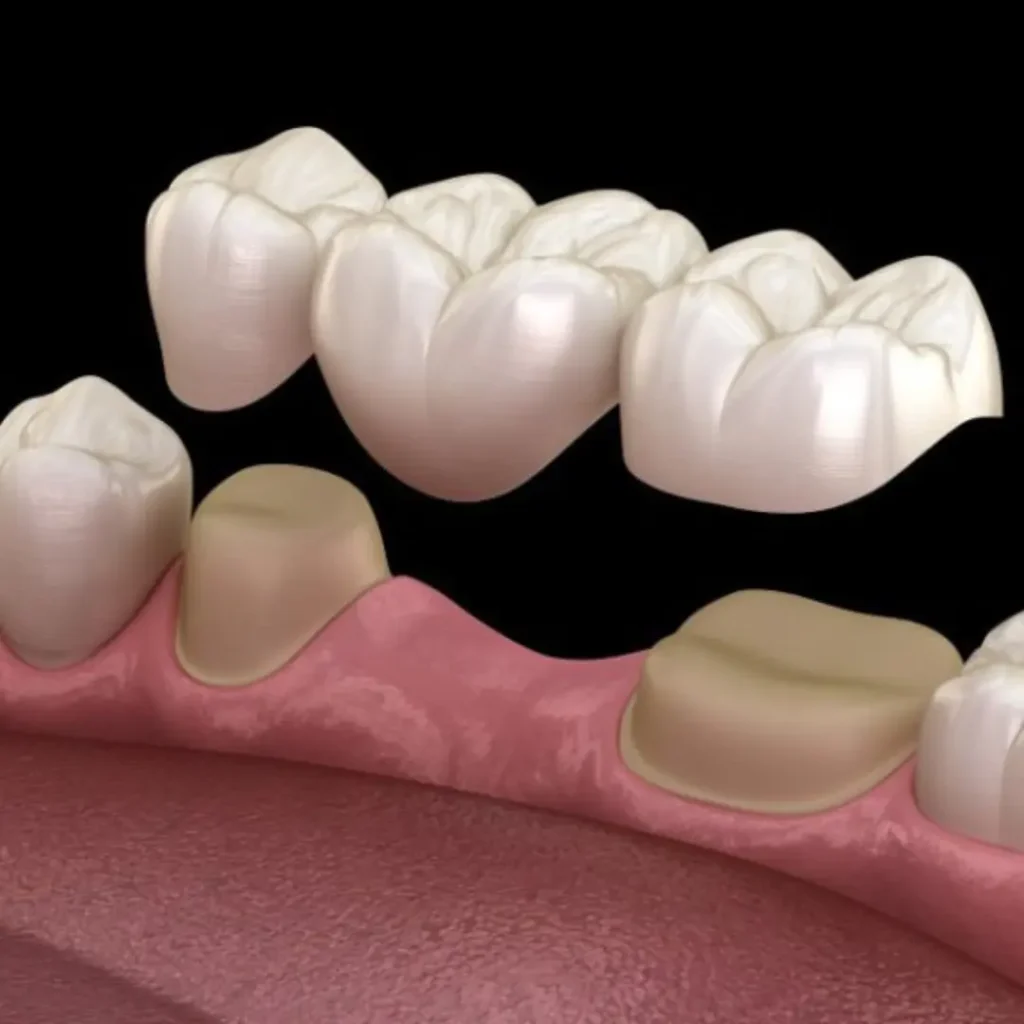 Accidental-damage-from-injury-or-biting-down-Upland-CA