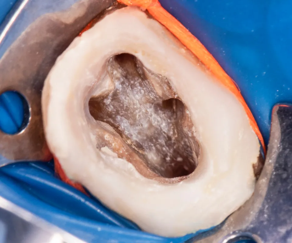 Cleaning-the-Root-Canal-Upland-CA