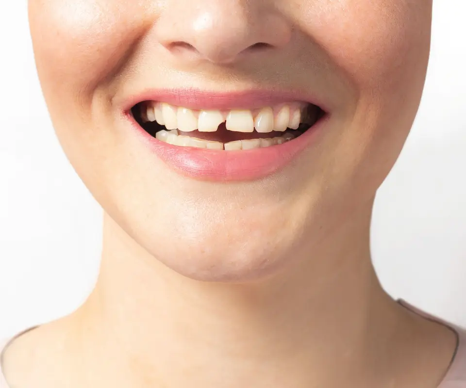 Cracked-or-Broken-Teeth-Upland-CA