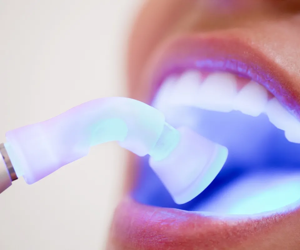 Dental-Bonding-or-Filling-Upland-CA