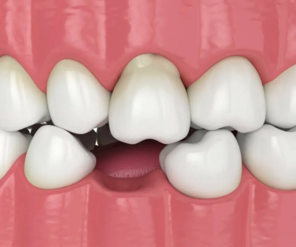 Dislocated-Teeth-Upland-CA