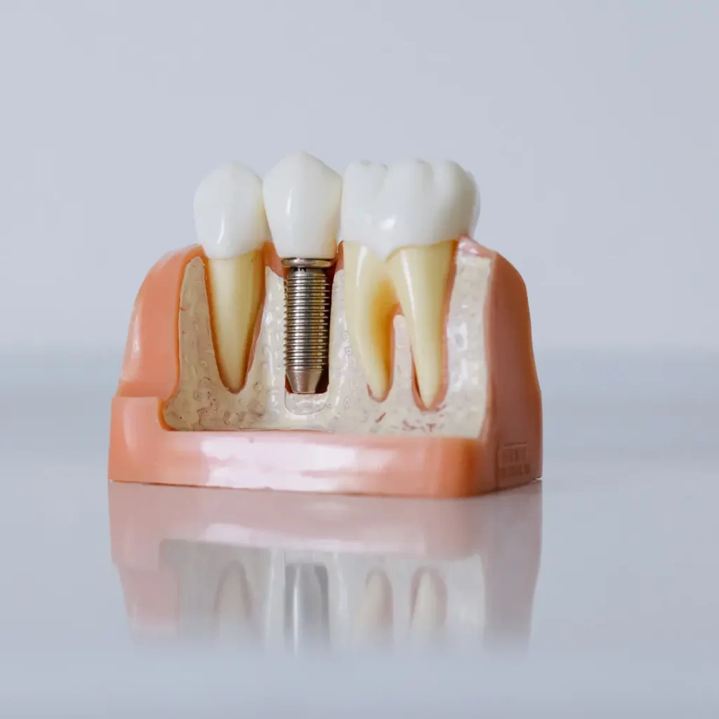 Emergency-Dental-Implant-Upland-CA