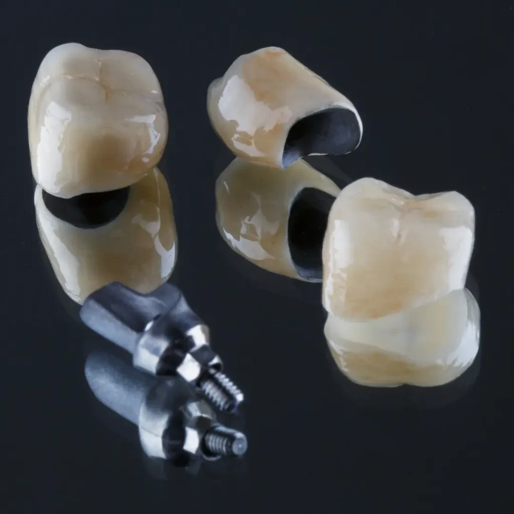 Loose-dental-bridge-or-crown-Upland-CA