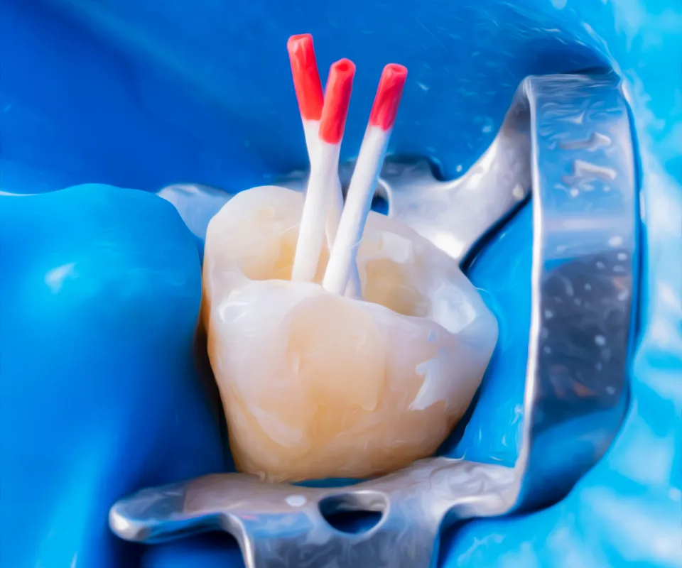 Root-Canal-Treatment-Process-Upland-CA