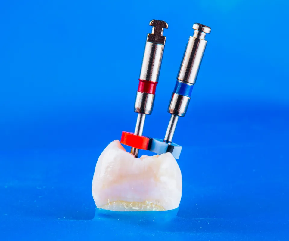 Root-Canal-Treatment-Upland-CA