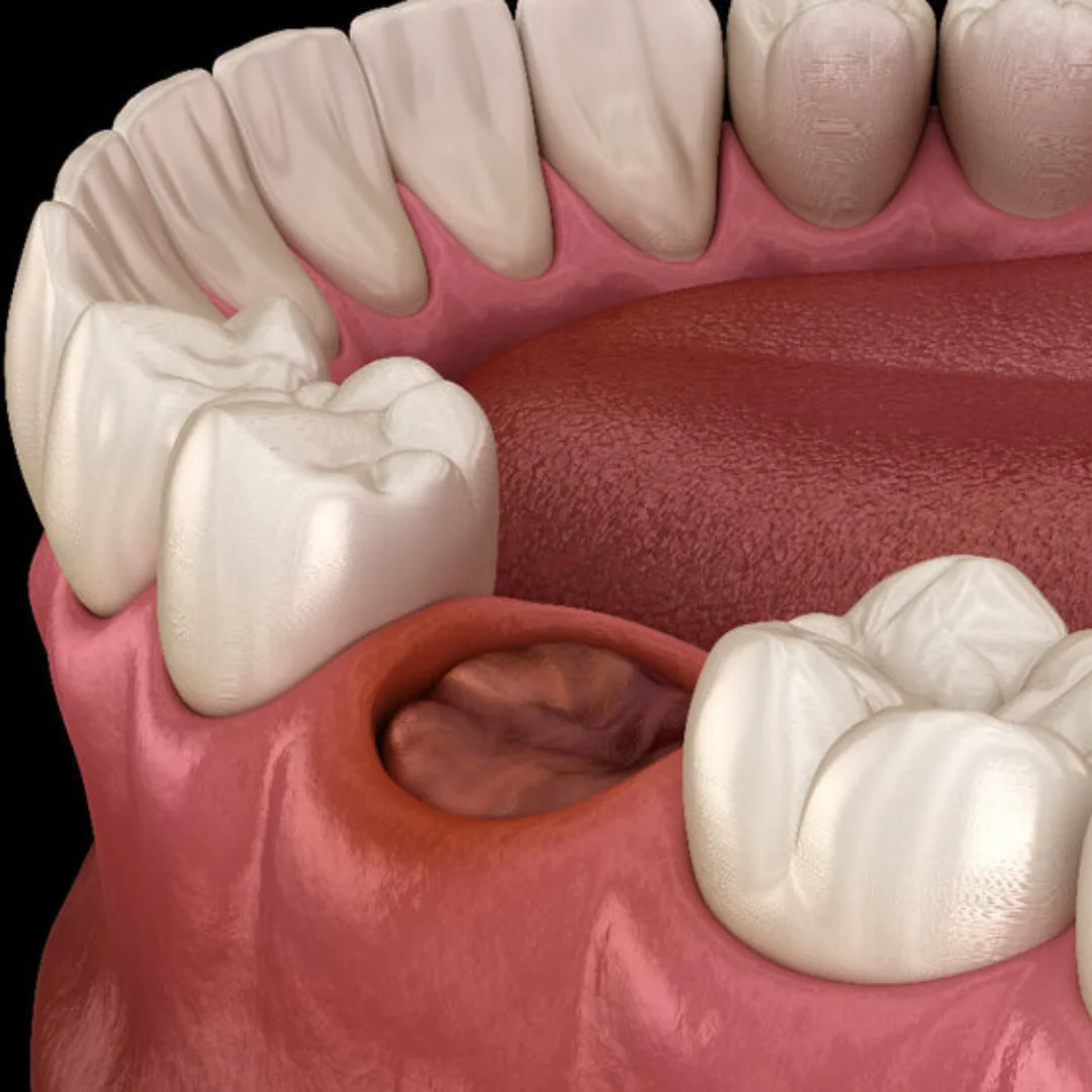 Symptoms-of-Dry-Socket-Upland-CA