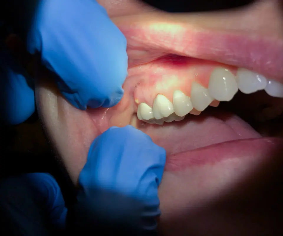 Tooth-Abscess-Upland-CA