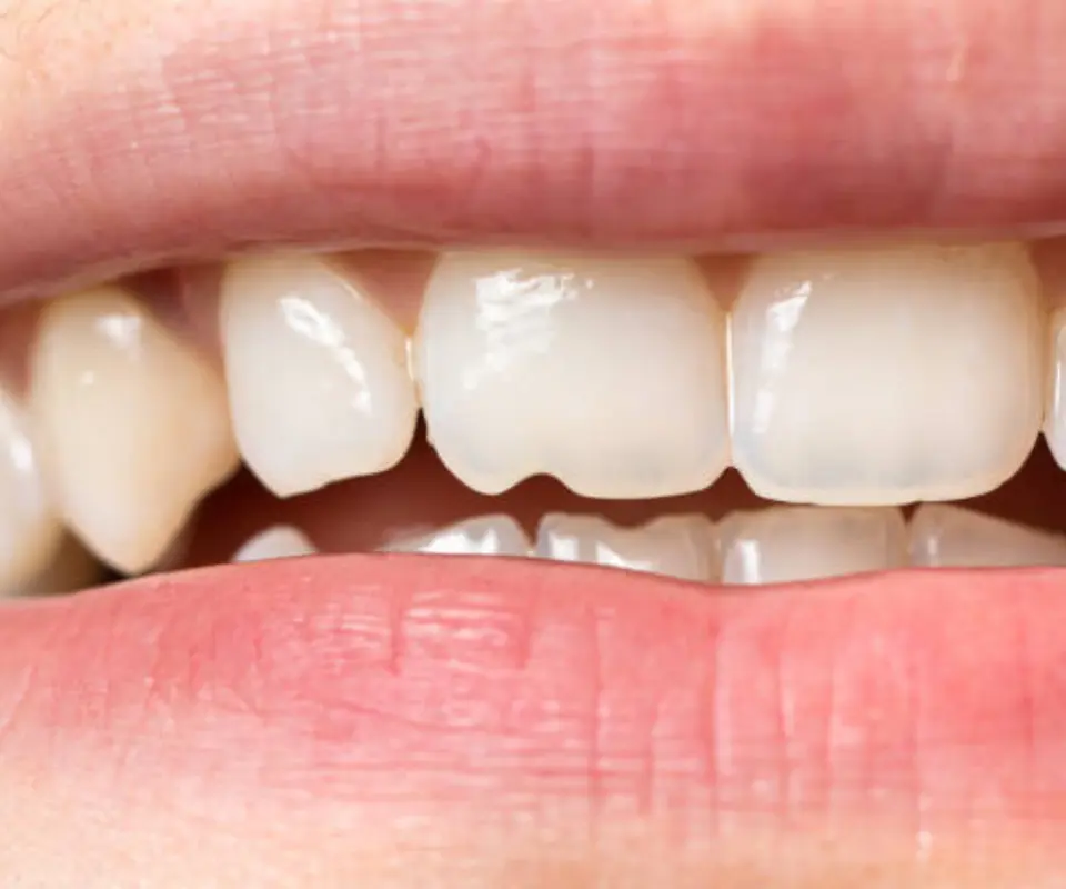 Tooth-Fractures-Upland-CA