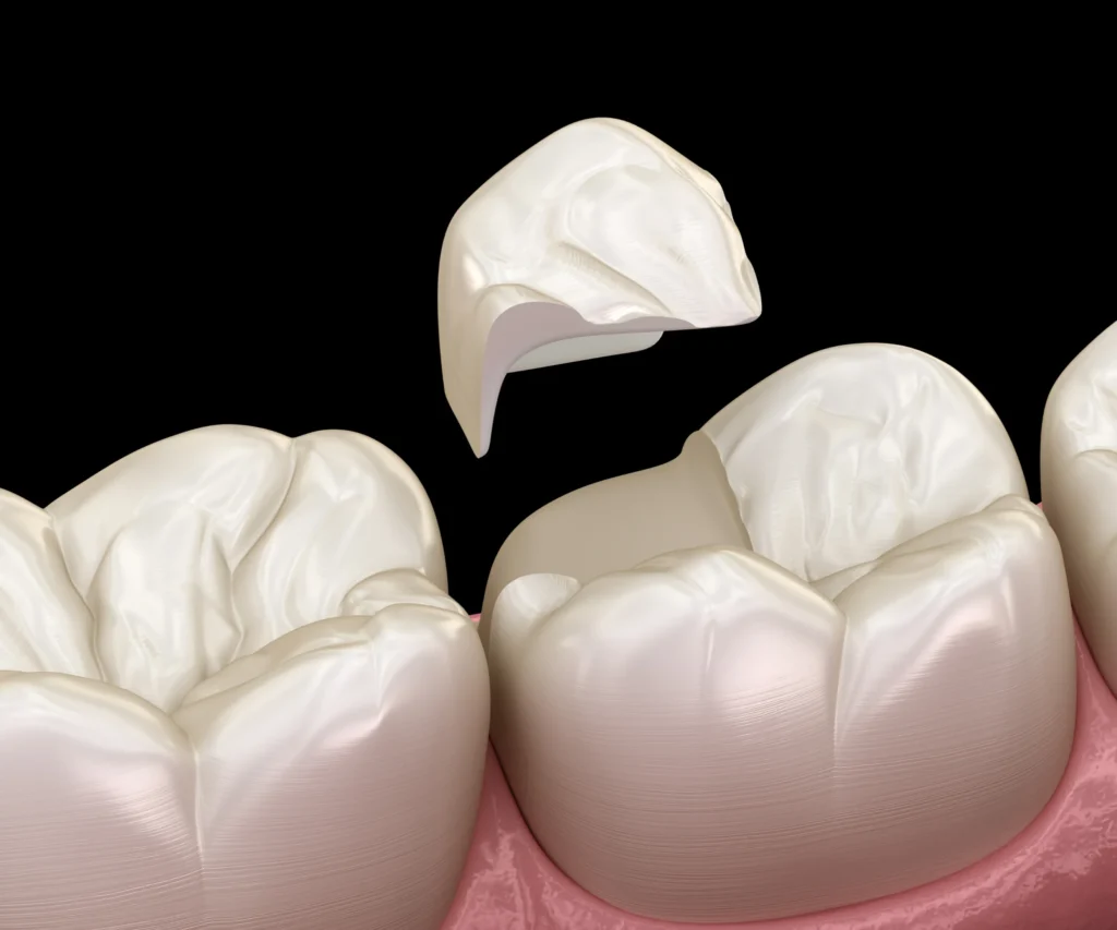 What-Causes-a-Cracked-Tooth-Upland-CA