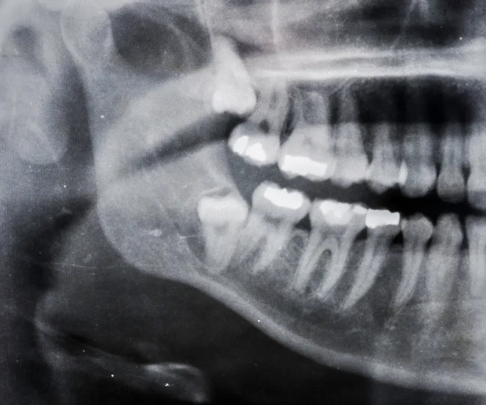 Wisdom-Tooth-Complications-Upland-CA