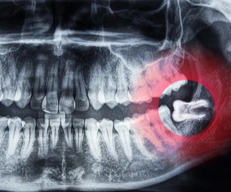 Wisdom-Tooth-Infection-Emergencies-Upland-CA