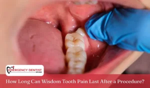 how-long-wisdom-tooth-pain-lasts-after-procedure