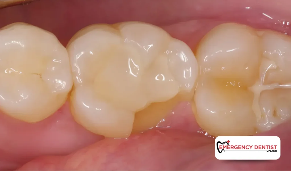 Why Might a Chipped Back Tooth Have No Pain